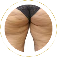celulitída